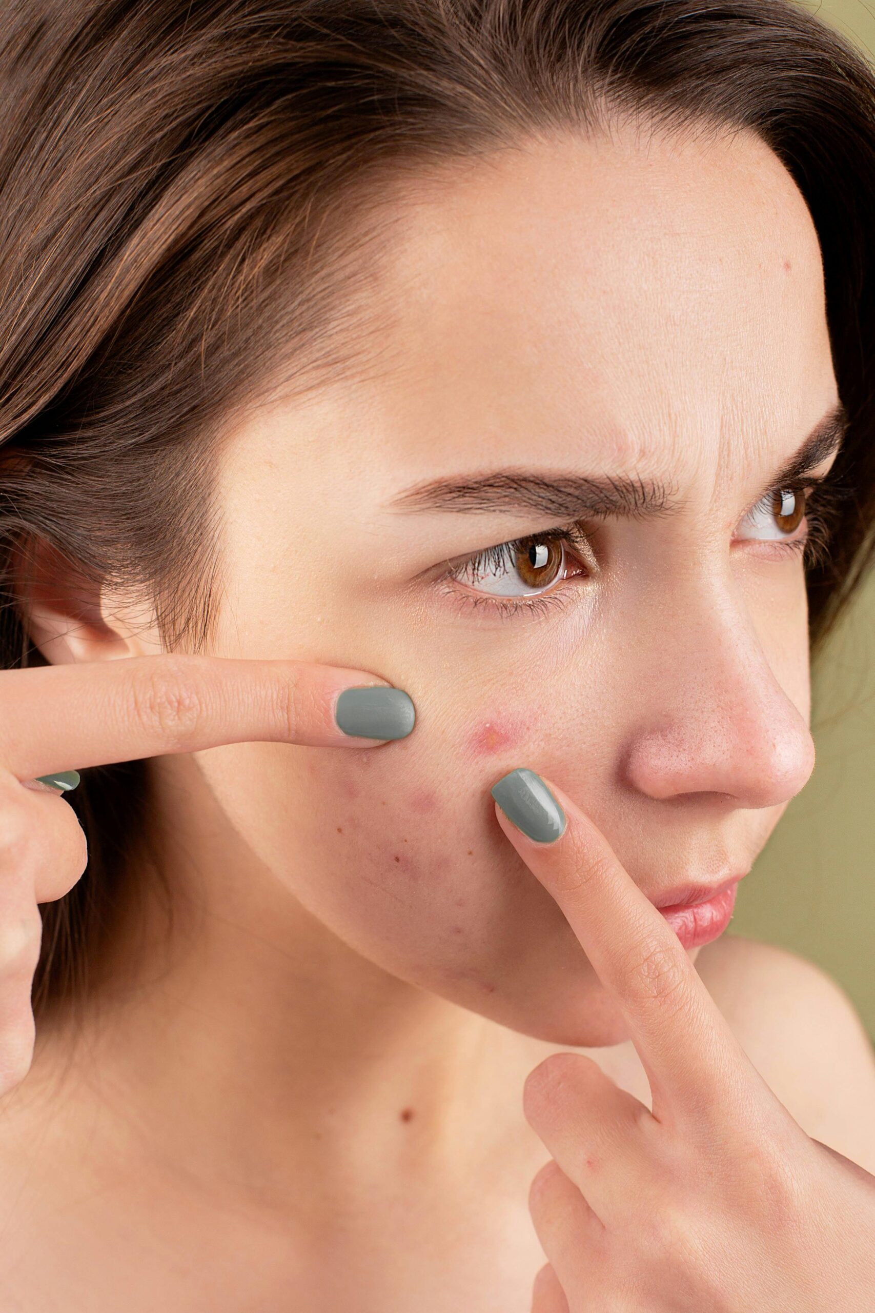 Permanent Solutions to Clear Adult Acne